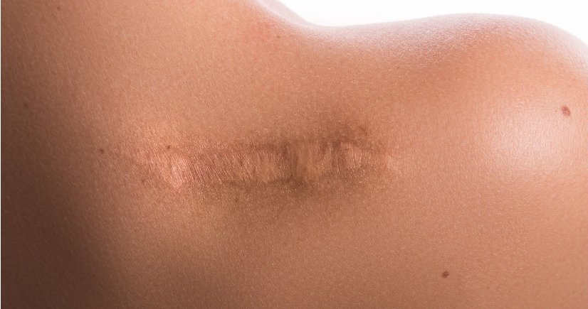 Keloid Treatment